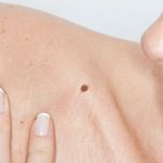 Bí ẩn về nốt ruồi son trên cơ thể